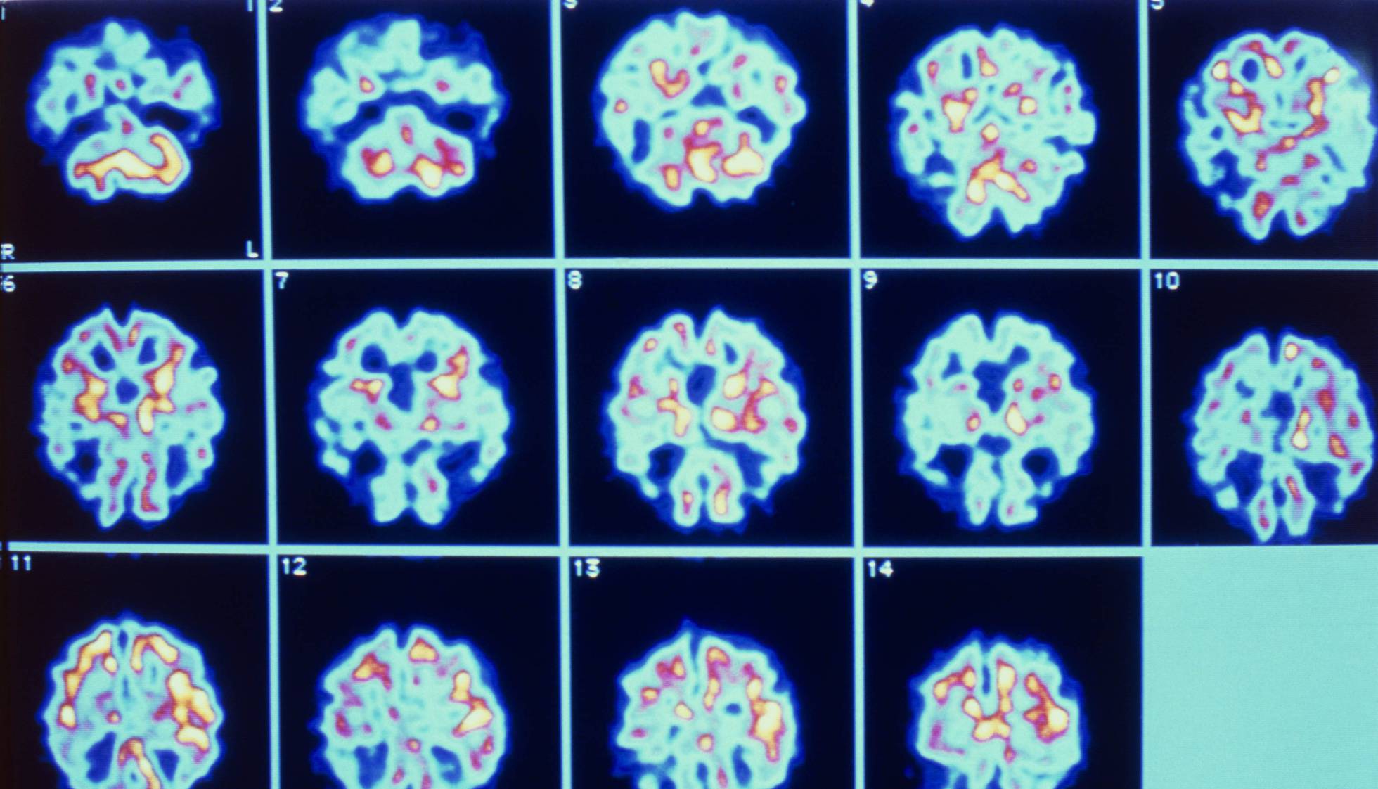 Uma caçada em busca dos primeiros sinais do mal de Alzheimer